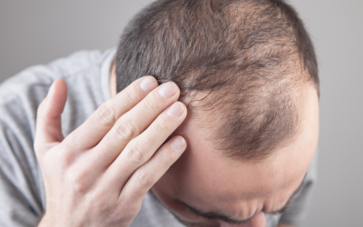 Mutter oder Vater: Wer vererbt den Haarausfall?